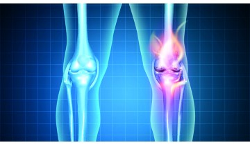 Gout & High Uric Acid